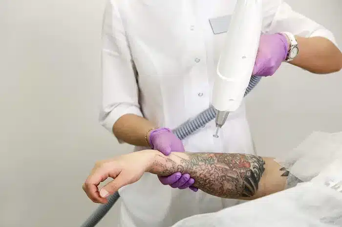 Tattoo Removal deals in Dubai